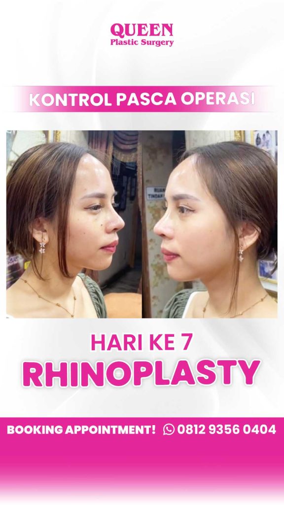 Bukan Sekadar Suara, Mendengkur Bisa Jadi Masalah Serius! ⚠️
Tahukah Anda kalau bentuk septum atau struktur hidung bisa memicu dengkur kronis? Operasi hidung (Rhinoplasty/Septoplasty) hadir sebagai solusi medis yang efektif. Pelajari prosedurnya bersama dr. Heri Noviana, SpBP-RE, M.Ked.Klin.
📖 Klik untuk baca artikel