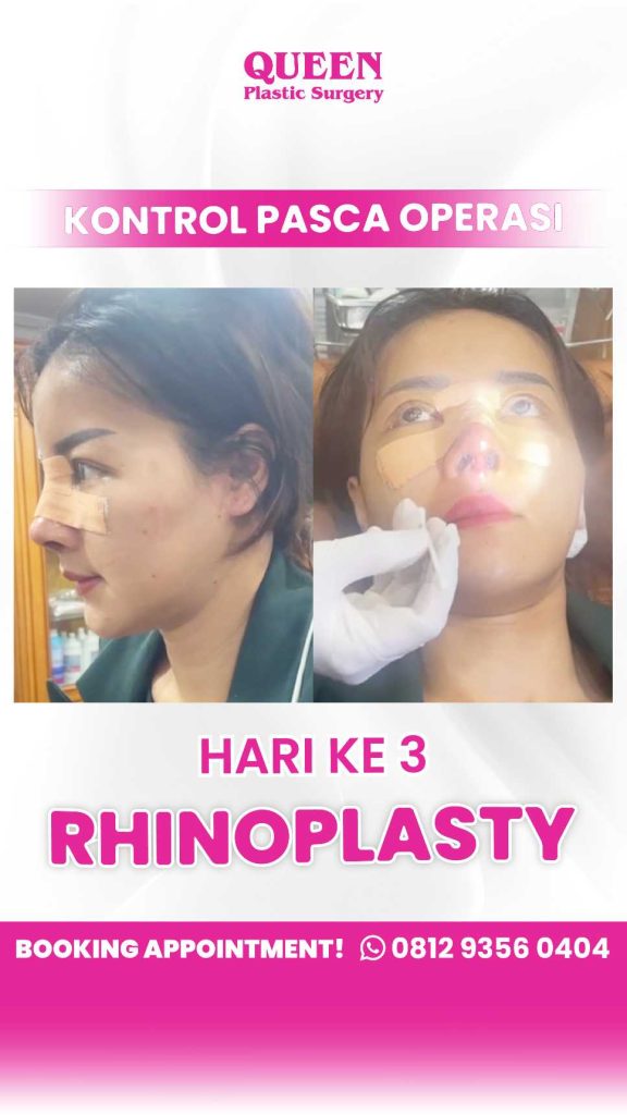 Sering Diprotes Pasangan Karena Ngorok? 😅
Jangan abaikan lagi! Mendengkur bukan hanya soal suara, tapi soal kesehatan pernapasan. Dapatkan penanganan tepat dari spesialis bedah plastik rekonstruksi, dr. Heri Noviana, SpBP-RE, M.Ked.Klin.
👇 Klik link berikut untuk solusinya