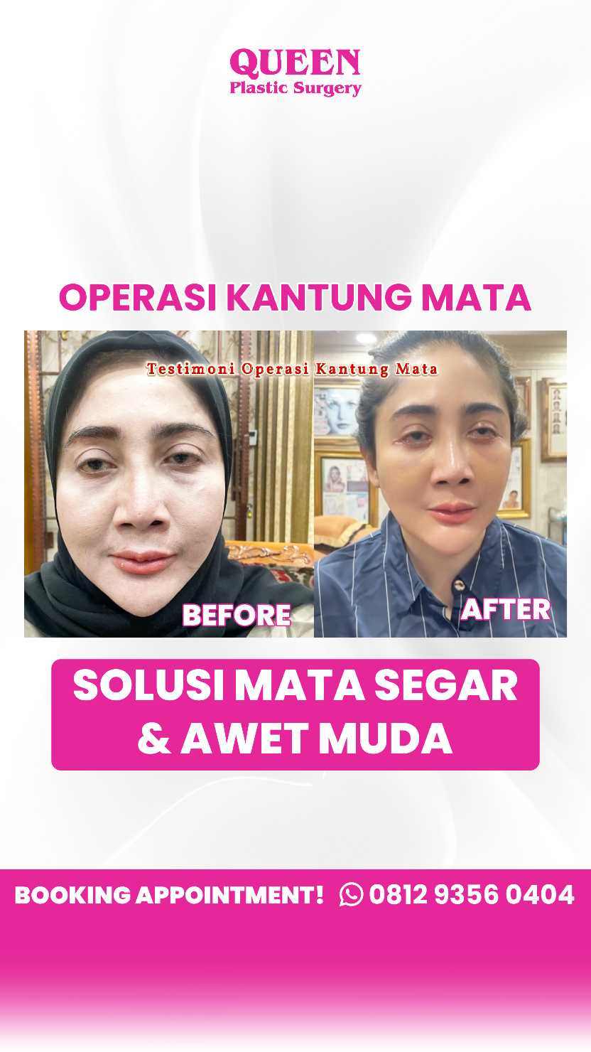 Kombinasi manfaat Blefaroplasti & Brow Lift: Investasi terbaik untuk wajah segar! 💖 Tanya dr. Heri Noviana, SpBP-RE.M.Ked.Klin sekarang.