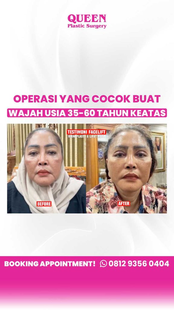 Mitos atau Fakta: Operasi tarik wajah bisa hilangkan kelopak mata kendur? Cek kebenarannya sekarang sebelum ambil tindakan!