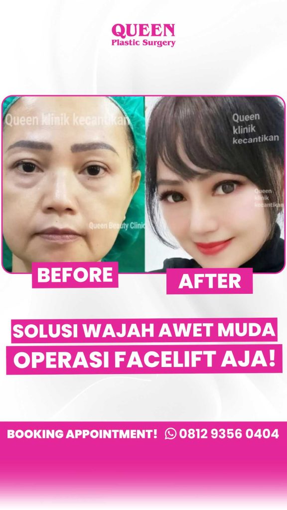 Hindari hasil wajah kaku! 🛑 Pilih teknik Facelift yang tepat: SMAS atau Deep Plane? Simak saran dr. Heri Noviana, SpBP-RE.M.Ked.Klin di sini.