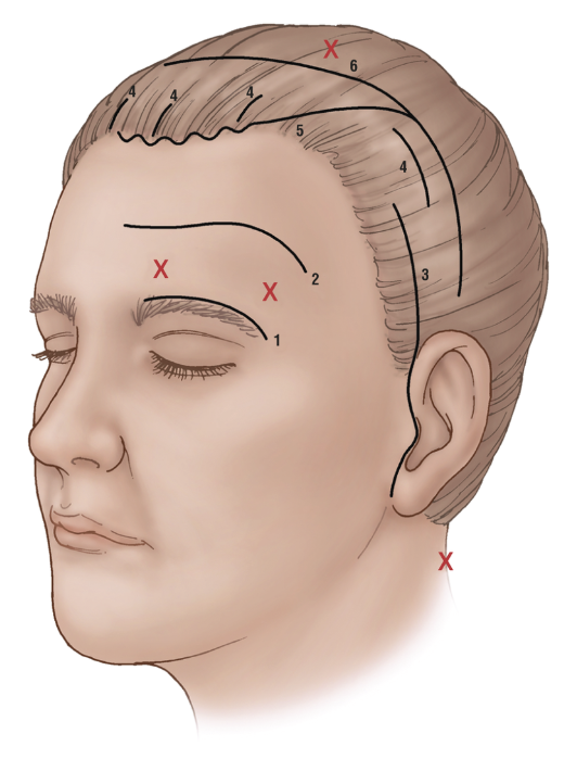 Alis turun bikin wajah 'galak'? 🤨 Ubah penampilanmu jadi lebih ramah & awet muda dengan Brow Lift. Konsultasi bersama dr. Heri Noviana, SpBP.RE-M.Ked.Klin!
