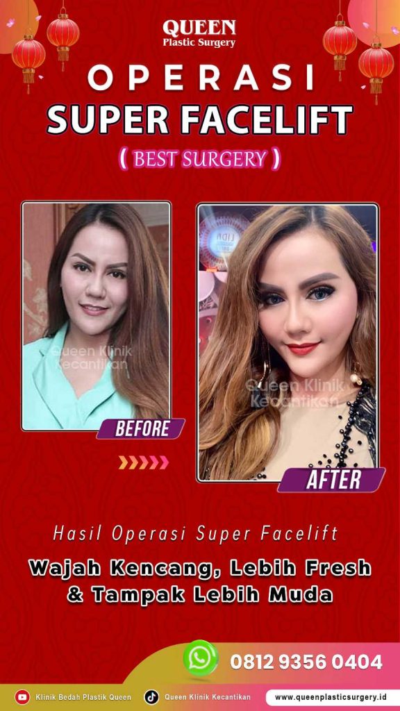 Dapatkan wajah kencang permanen yang tetap fleksibel saat tersenyum. 😊 Simak keunggulan Facelift SMAS bersama dr. Heri Noviana, SpBP.RE-M.Ked.Klin di artikel ini.