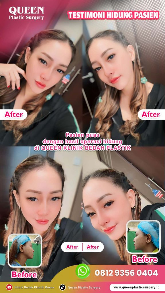 Investasi wajah: Pilih bahan Rhinoplasty yang paling tahan lama dan aman. Konsultasikan dengan dr. Heri Noviana, SpBP-RE.M.Ked.Klin.