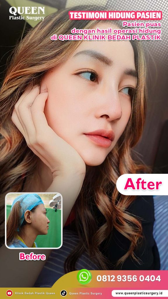 Hidung proporsional tanpa drama infeksi! 🛑 Pilih bahan rhinoplasty yang tepat sesuai saran dr. Heri Noviana, SpBP-RE.M.Ked.Klin.