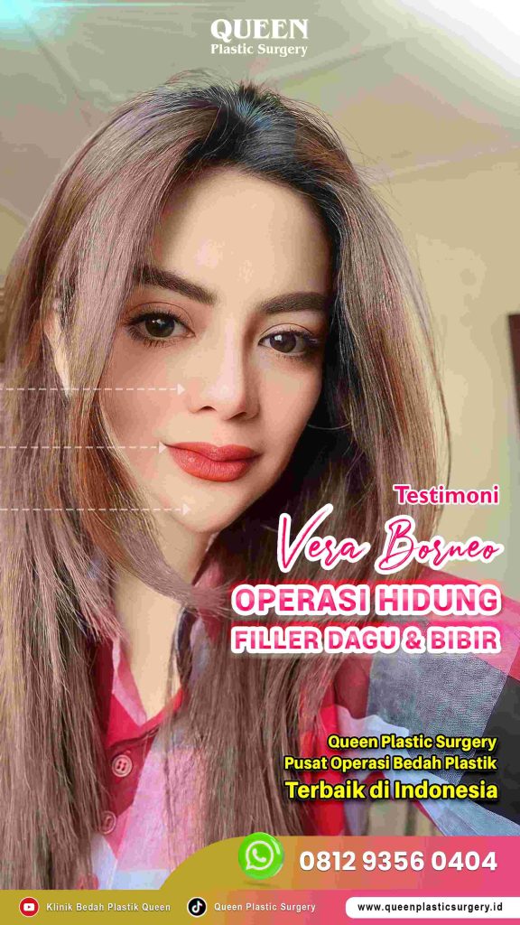 Ternyata ini alasan kenapa hasil Rhinoplasty orang lain terlihat lebih natural! ✨ Konsultasikan bahan rhinoplasty terbaikmu dengan dr. Heri Noviana, SpBP-RE.M.Ked.Klin.
👉 Lihat rahasianya