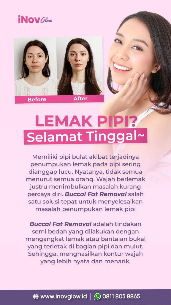 Wajah tirus tanpa filter bukan cuma mimpi. ✨ Simak prosedur Sedot Lemak Pipi yang lagi tren bersama dr. Heri Noviana.