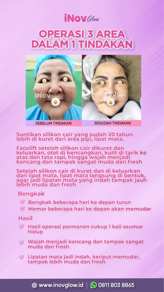 Kembalikan kepercayaan diri dengan leher yang kencang dan indah. 👑 Simak panduan lengkap Lower Facelift dari Dr. Heri Noviana.