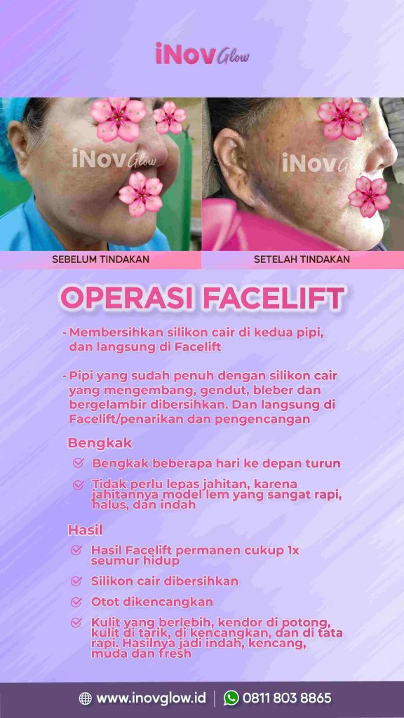 Siap tampil memukau dari sudut mana saja? 📸 Intip cara atasi kerutan wajah bawah bersama ahlinya, Dr. Heri Noviana.