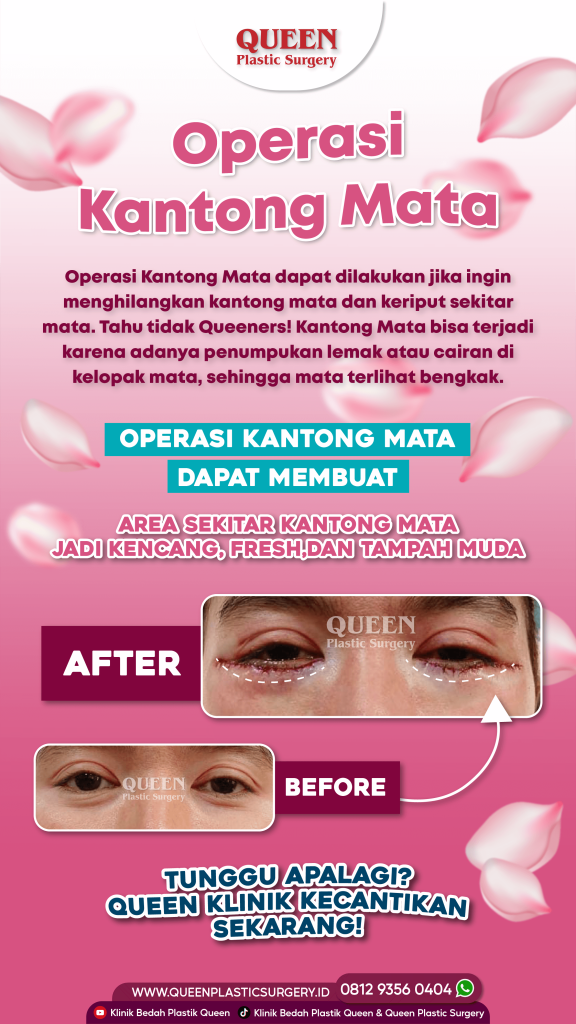 Bukan sekadar operasi plastik biasa! Ini rahasia transformasi mata segar maksimal 💎. Pelajari metode manfaat blefaroplasti & konsultasi dengan dr. Heri Noviana, SpBP-RE.M.Ked.Klin.