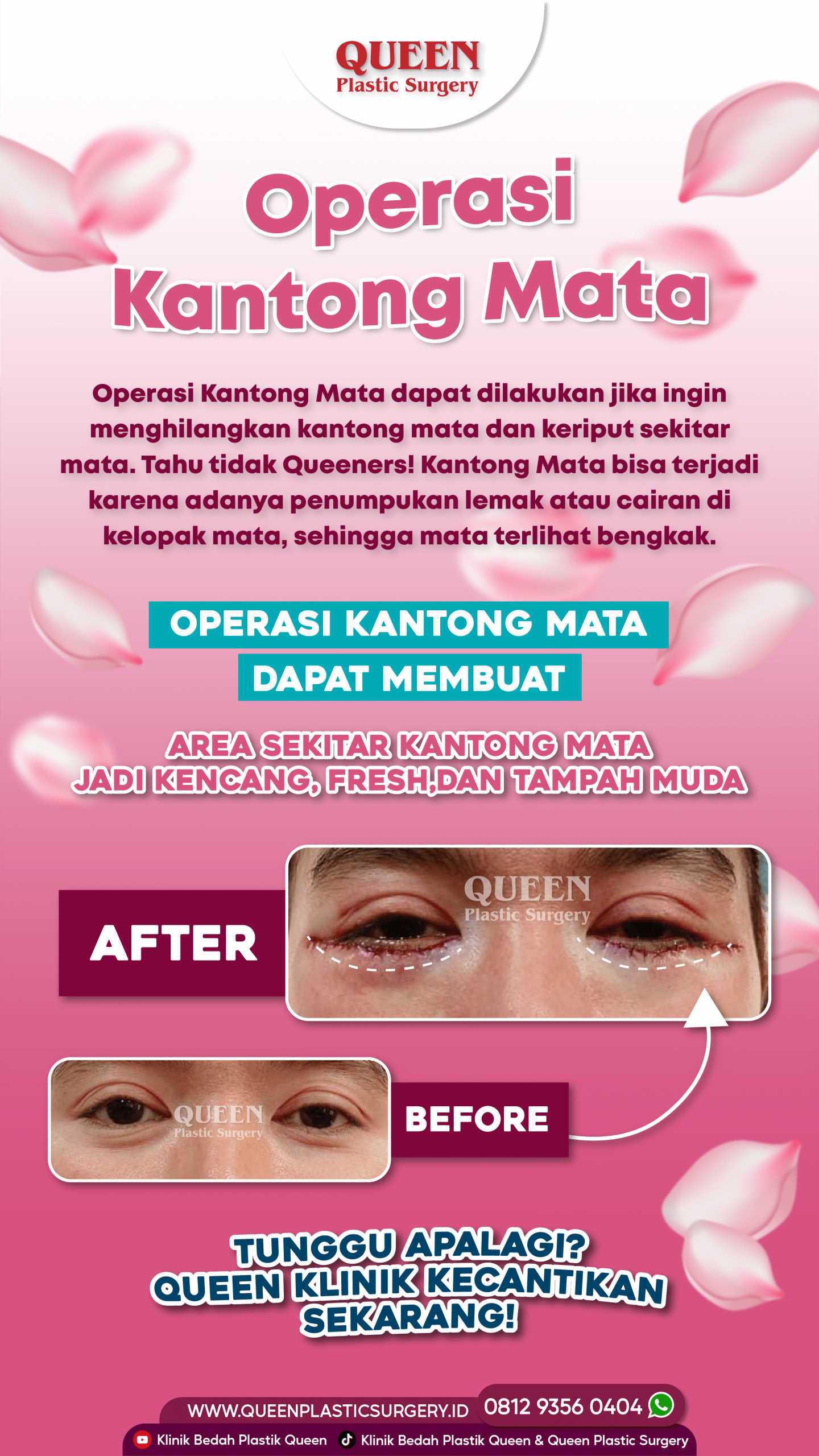 Bukan sekadar operasi plastik biasa! Ini rahasia transformasi mata segar maksimal 💎. Pelajari metode manfaat blefaroplasti & konsultasi dengan dr. Heri Noviana, SpBP-RE.M.Ked.Klin.