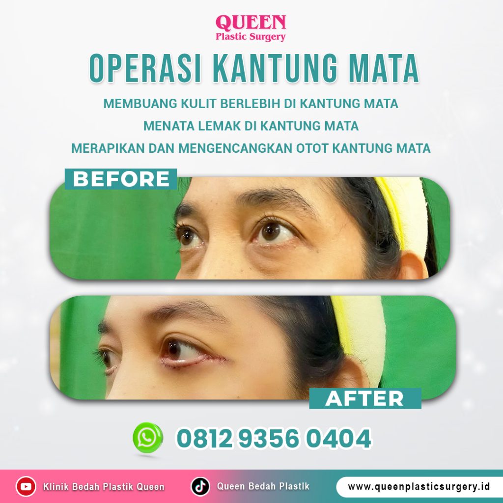 Hemat waktu pemulihan dengan prosedur kombinasi! 🛌 Simak tips masa pemulihan dari menggabungkan Facelift & Blefaroplasti di artikel ini.