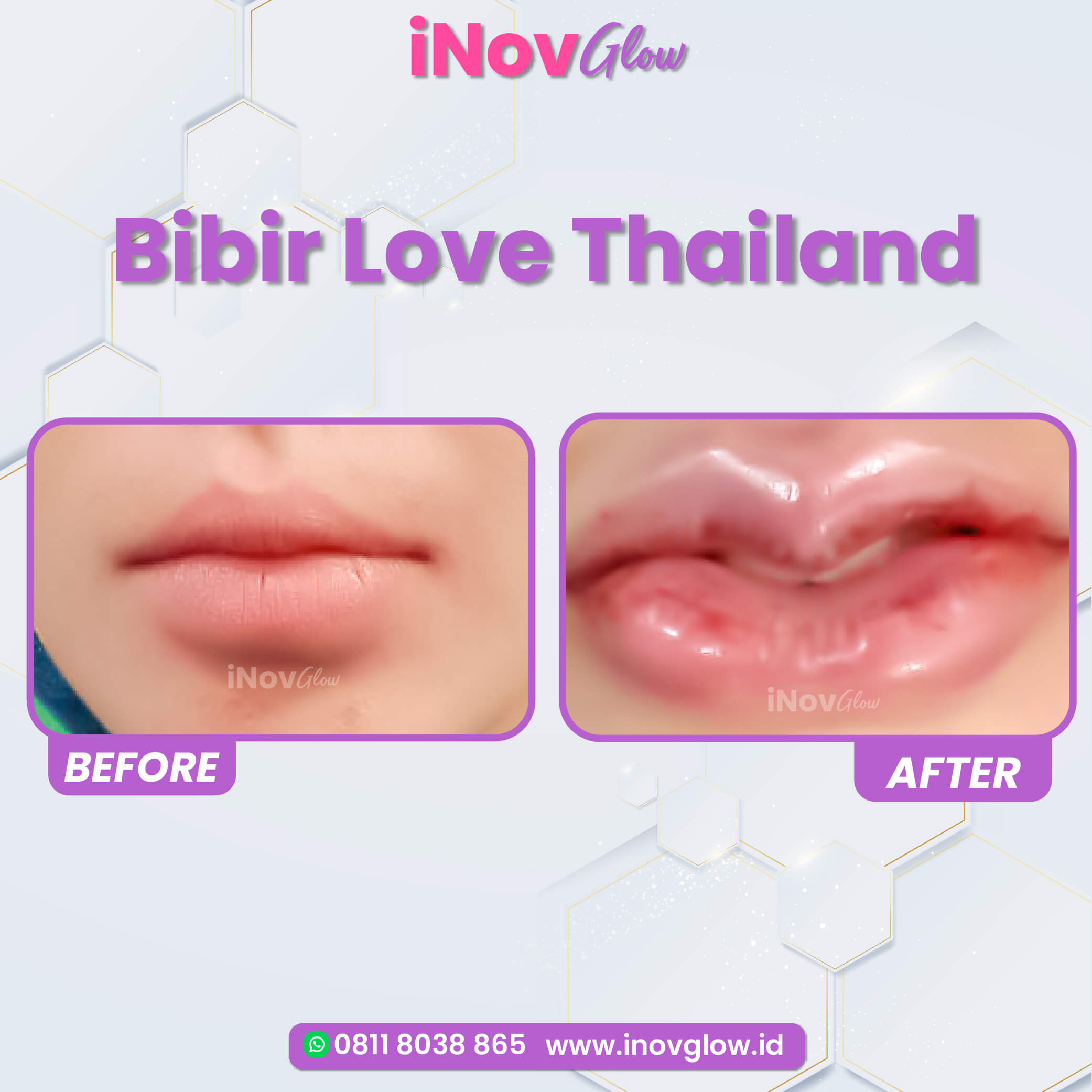 Aman dan tahan lama! Temukan langkah-langkah medis Transfer lemak bibir yang minim risiko bersama dr. Heri Noviana