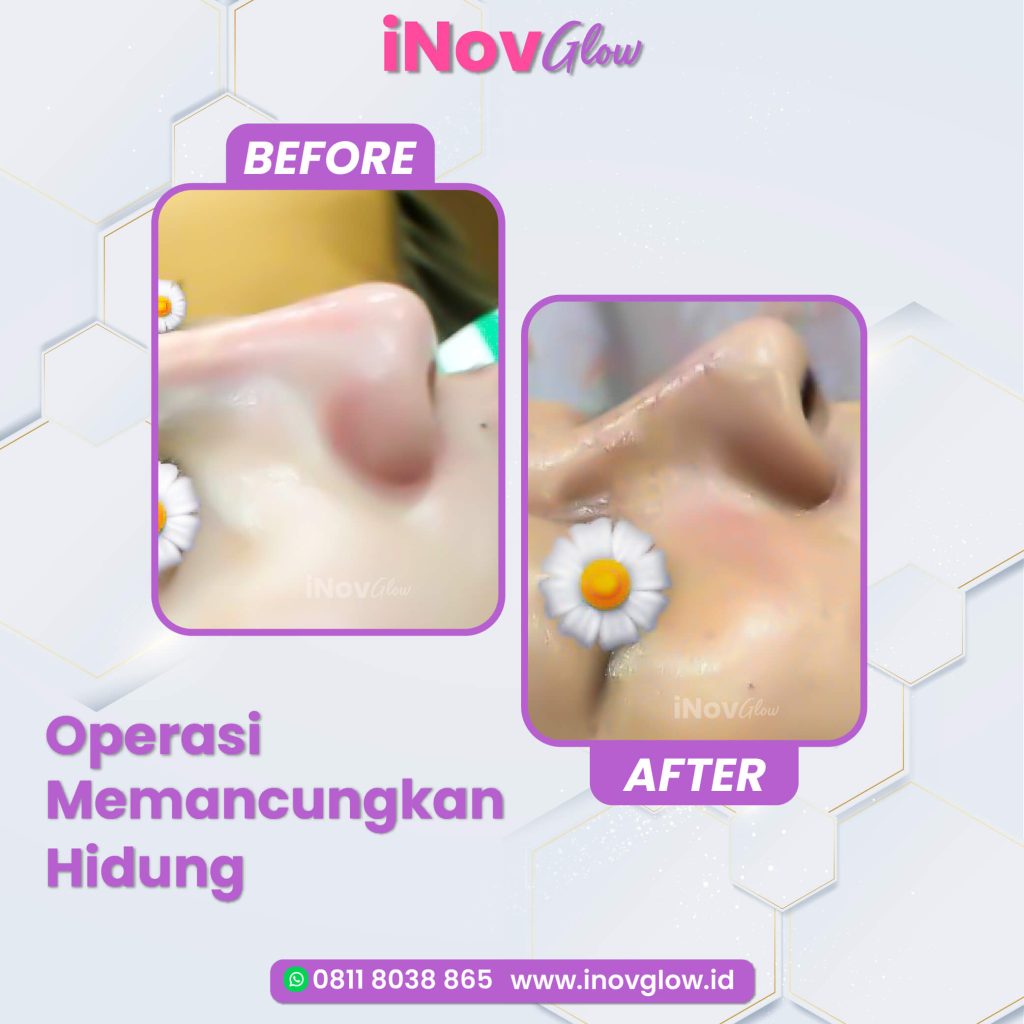 Banyak yang belum tahu! Ini perbedaan nyata hasil Implan silikon vs Tulang Rawan pada Rhinoplasty. Jangan lewatkan penjelasannya.