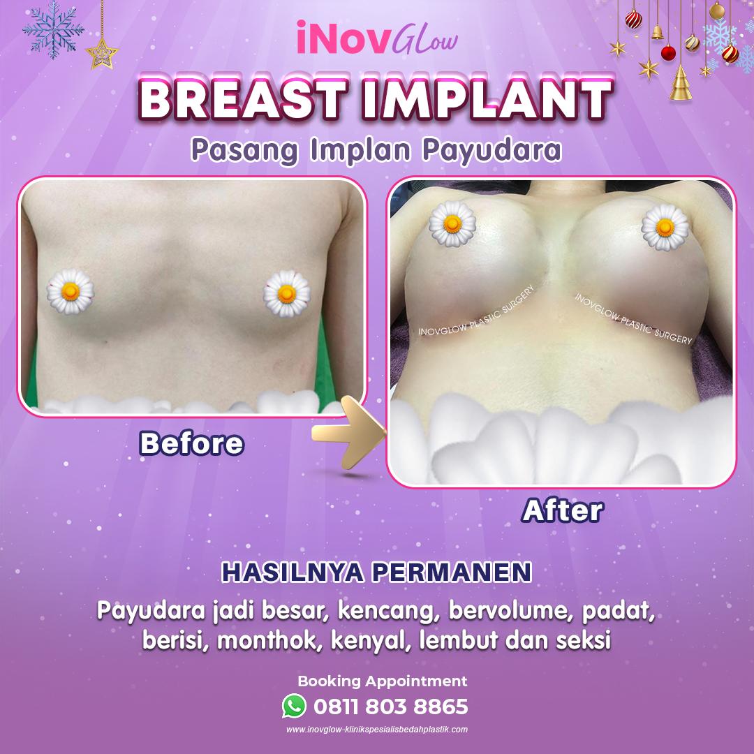 Ingin hasil maksimal tanpa mengorbankan kesehatan? ✨ Ini rahasia keamanan implan payudara modern dari dr. Heri Noviana, SpBP-RE,M..Ked.Klin