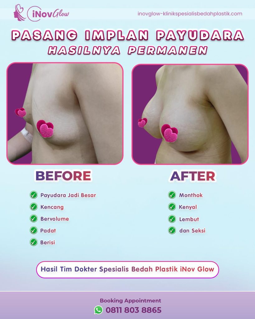 Mau payudara kencang tanpa rasa khawatir? 🌟 Cek metode pengencangan payudara dengan transfer lemak yang sedang tren di sini. Konsultasi dengan Dr. Heri Noviana!