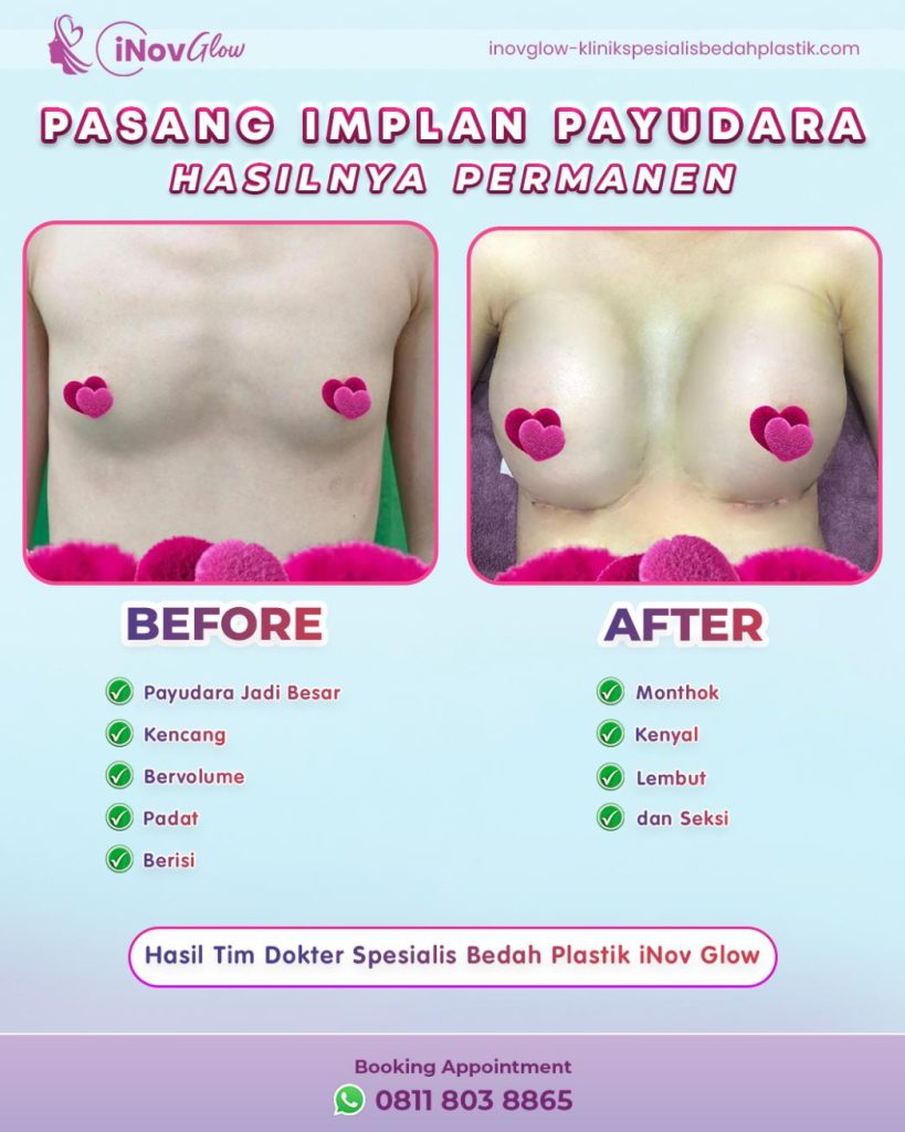 Ingin volume payudara bertambah tapi tetap terasa natural saat disentuh? ✨ Pengencangan Payudara dengan Transfer lemak jawabannya. Konsultasi dengan Dr. Heri Noviana yuk