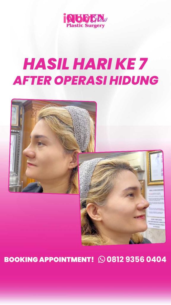 Hidung mancung tapi tetap lembut disentuh? 👃 Pilih bahan rhinoplasty yang tepat! Cek opsinya bersama dr. Heri Noviana di sini.