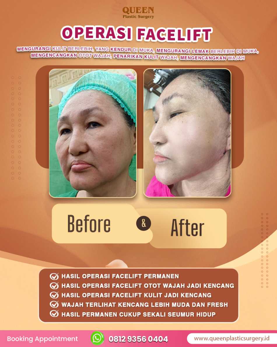 Rahasia wajah 'kembali ke usia 20-an' tanpa terlihat seperti habis operasi! ✨ Cek keunggulan Deep Plane Facelift bersama dr. Heri Noviana, SpBP-RE.M.Ked.Klin.