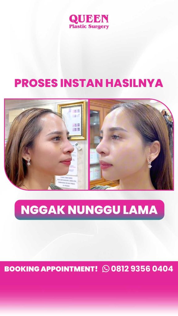 Tampil percaya diri dengan hidung proporsional. Pilih bahan rhinoplasty yang paling pas buat anatomi wajahmu!