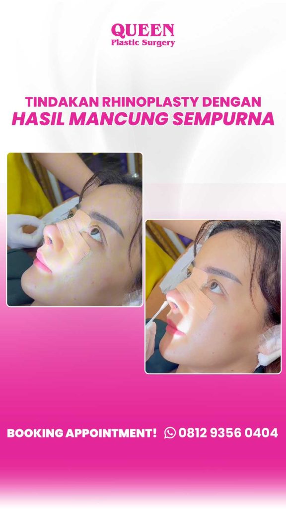 Pilihan bahan Rhinoplasty terbaik 2026! 📈 Mana yang pas buat kamu? Tanya dr. Heri Noviana sekarang juga.