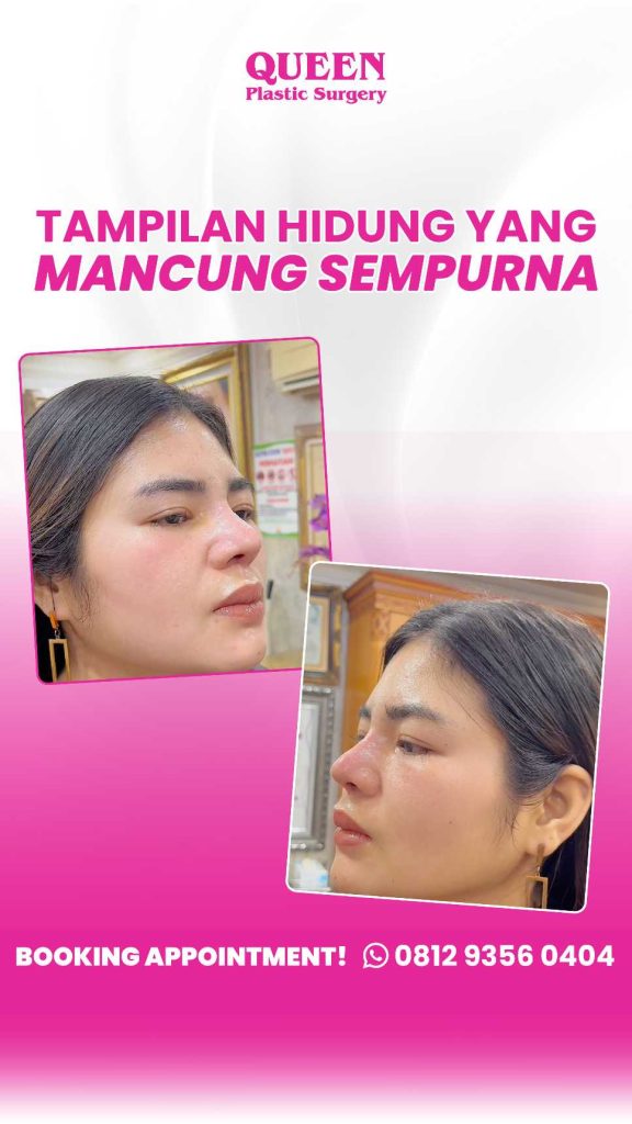 Investasi seumur hidup! Pilih bahan Rhinoplasty berkualitas agar tidak menyesal. Konsultasikan dengan dr. Heri Noviana hari ini.
