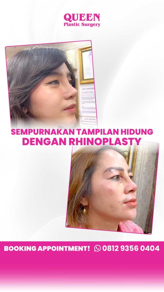Mau hasil Rhinoplasty anti-geser? 🛡️ Kenali pilihan bahan rhinoplasty terbaik hanya di sini. Konsultasikan dengan dr. Heri Noviana!