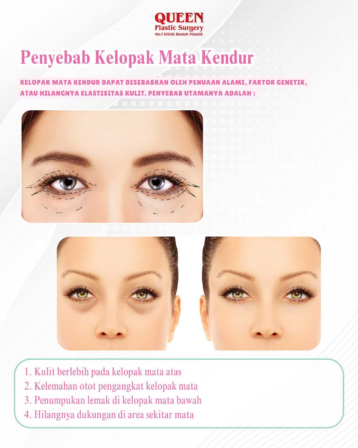 Kembalikan binar matamu! ✨ Temukan kaitan antara wajah kencang dan kelopak mata segar di panduan lengkap dr. Heri Noviana.