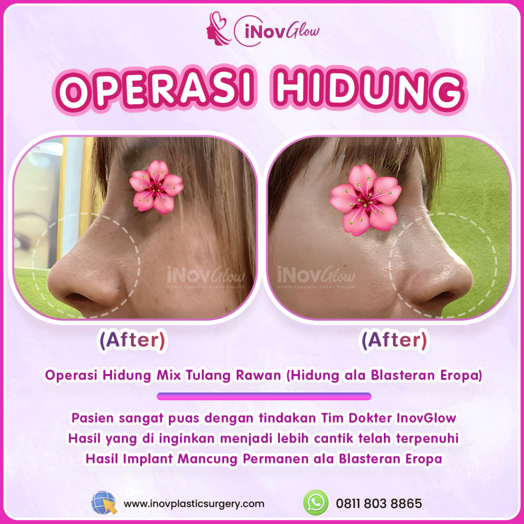 Implan Silikon vs Tulang Rawan: Mana yang lebih cocok dengan anatomi wajah Anda? ✨ Konsultasikan hasilnya dengan dr. Heri Noviana sekarang.