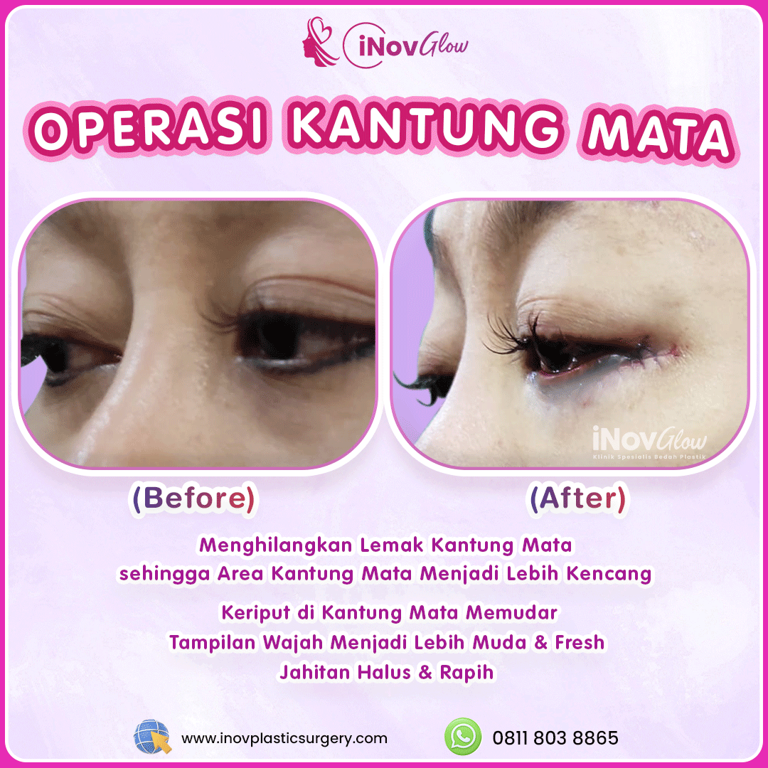 Aman dan terpercaya: Pastikan prosedur area kantung mata Anda ditangani oleh ahlinya. Konsultasikan dengan dr. Heri Noviana, SpBP-RE hari ini!