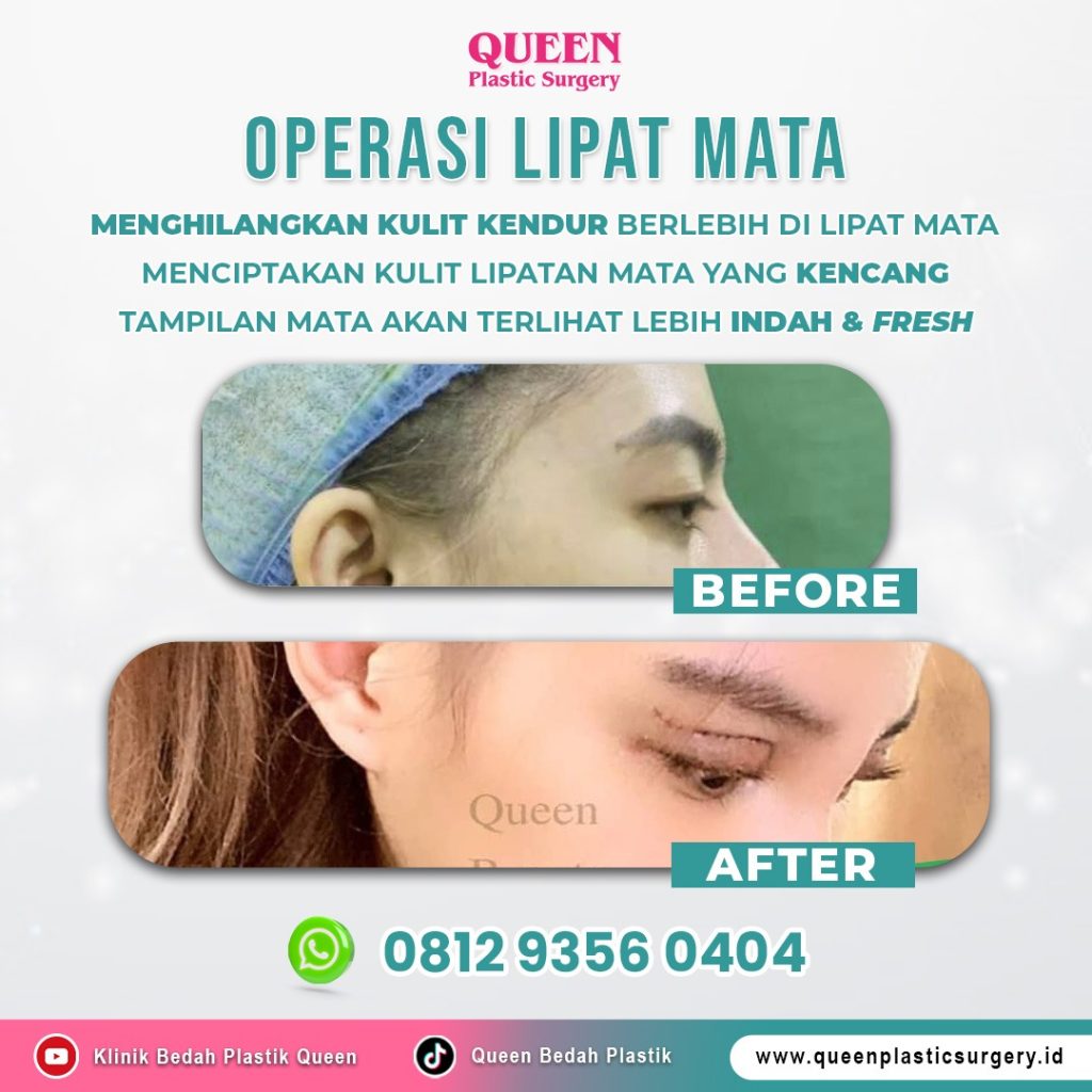 Definisi cantik proporsional ada di sini. 🌟 Yuk, kenali kombinasi menggabungkan Facelift dan Blefaroplasti untuk hasil maksimal!