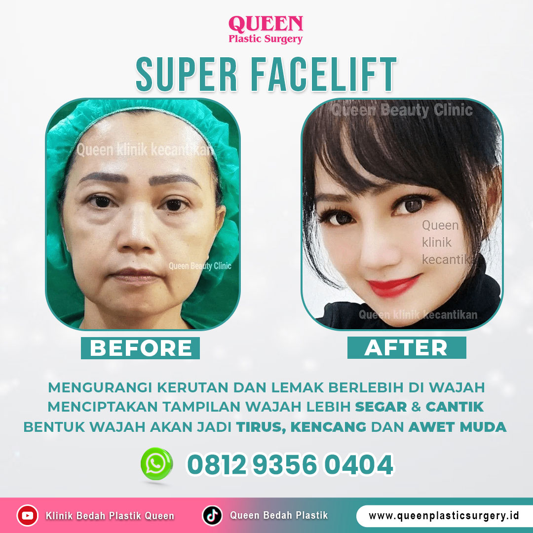 Sekali jalan, dua masalah tuntas! ⏱️ Kenapa menggabungkan Facelift & Blefaroplasti jauh lebih efektif? Temukan jawabannya di sini.