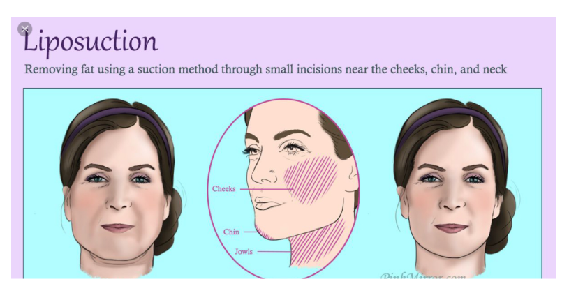 "Wajah tirus tanpa filter bukan cuma mimpi. ✨ Simak prosedur Sedot Lemak Pipi yang lagi tren bersama dr. Heri Noviana.