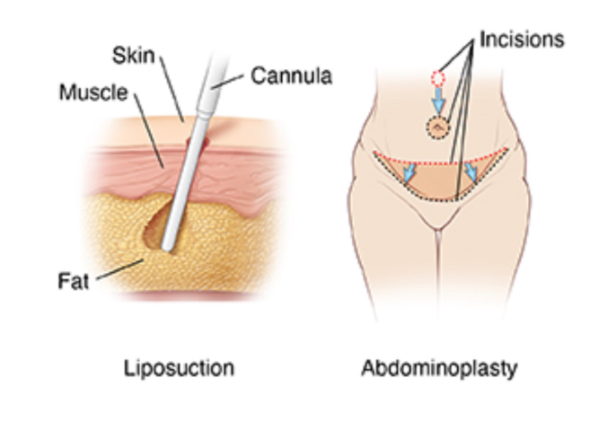 Bukan sekadar buang lemak! Ini alasan kenapa Liposuction pada operasi pengencangan perut jadi 'senjata rahasia'. Cek detailnya bersama dr. Heri Noviana, SpBP-RE.M.Ked.Klin