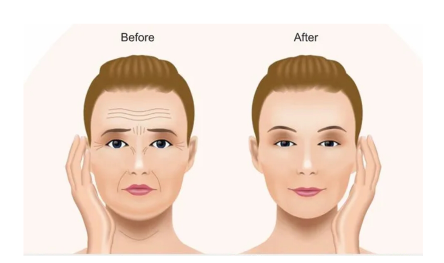 Apa yang terjadi jika menggabungkan Facelift dan Blefaroplasti dilakukan bersamaan? 📈 Hasilnya bakal bikin kamu takjub! Baca selengkapnya.