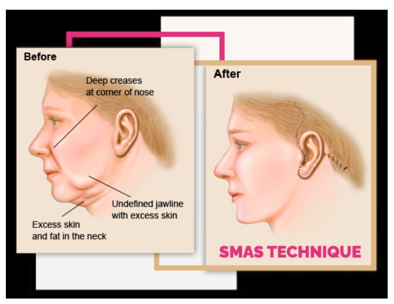 Wajah kencang maksimal hingga ke lapisan otot! 💪 Cek manfaat SMAS Facelift bersama dr. Heri Noviana, SpBP-RE.M.Ked.Klin di sini.