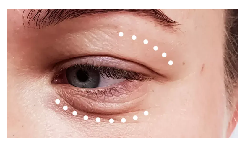 Ucapkan selamat tinggal pada kelopak mata yang 'tenggelam'! 👋 Temukan keajaiban manfaat Blefaroplasti & Brow Lift di sini. Hubungi dr. Heri Noviana, SpBP-RE.M.Ked.Klin sekarang.
