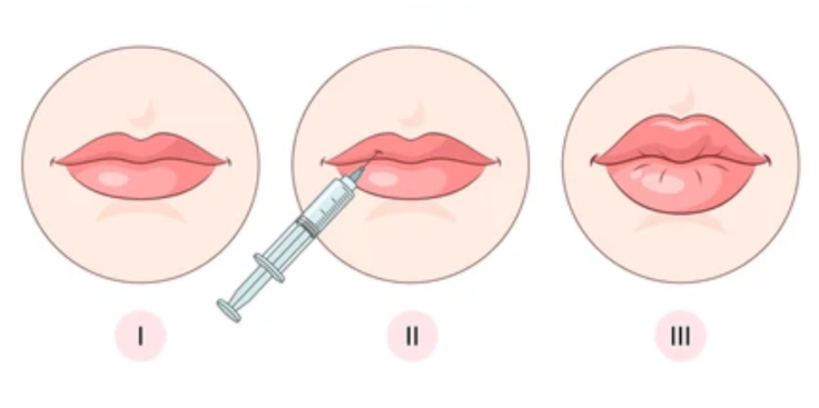 Mau bibir penuh tapi takut terlihat kaku? ✨ 
Transfer lemak bibir jawabannya! Hasil natural, lembut, dan permanen. Tanya dr. Heri Noviana, SpBP-RE.M.Ked.Klin yuk!