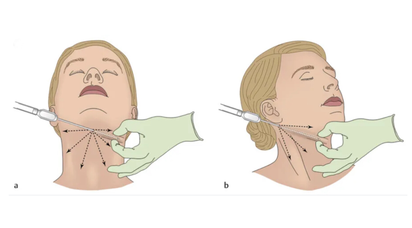 Double chin membandel meski sudah diet? 🤨 Mungkin ini solusi yang Anda cari. Pelajari sedot lemak leher bersama dr. Heri Noviana, SpBP-RE.M.Ked.Klin!
