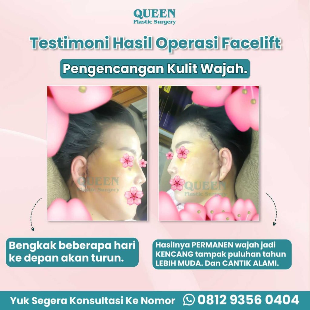 Bedah tuntas manfaat SMAS Facelift: Aman, efektif, dan awet muda lebih lama. 🏥 Konsultasikan rencana Anda dengan dr. Heri Noviana, SpBP-RE.M.Ked.Klin