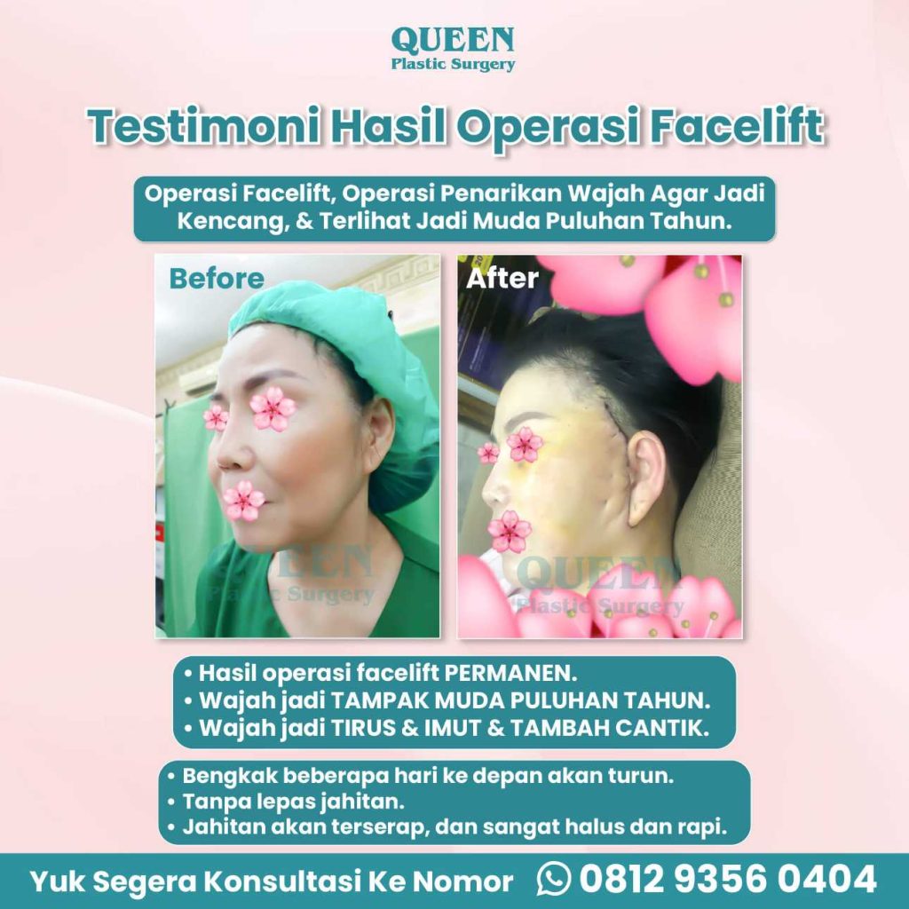 Tampil segar tanpa terlihat 'habis operasi'. 🎭 Simak keajaiban manfaat SMAS Facelift di artikel ini sekarang!