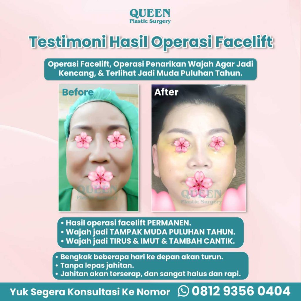 Jangan asal pilih prosedur facelift! 🛑 Ketahui kenapa manfaat SMAS Facelift jauh lebih unggul untuk jangka panjang. Tanya dr. Heri Noviana, SpBP-RE.M.Ked.Klin sekarang.