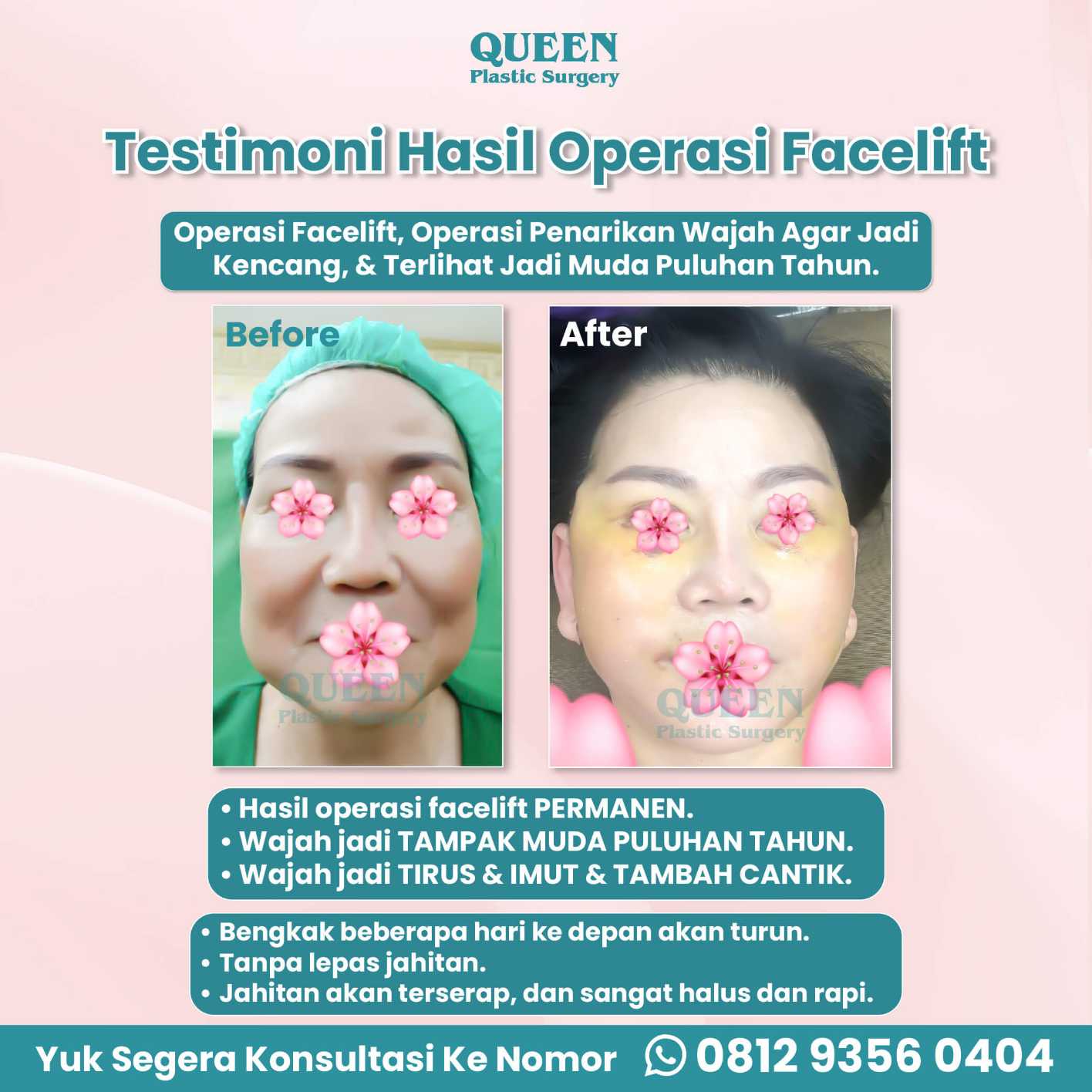Jangan asal pilih prosedur facelift! 🛑 Ketahui kenapa manfaat SMAS Facelift jauh lebih unggul untuk jangka panjang. Tanya dr. Heri Noviana, SpBP-RE.M.Ked.Klin sekarang.