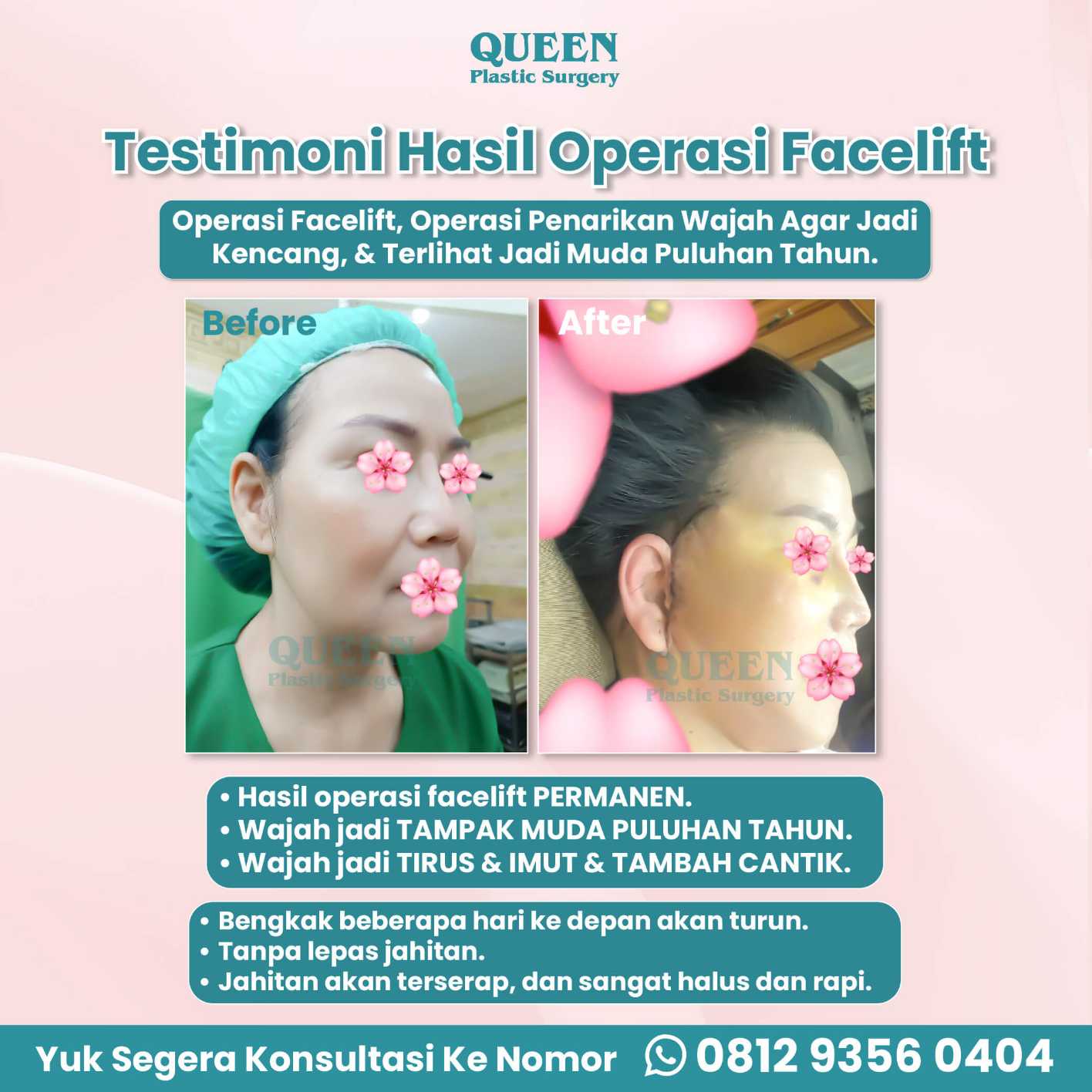 Ucapkan selamat tinggal pada jowls dan kulit kendur! 👋 Pelajari manfaat luar biasa SMAS Facelift di artikel ini.