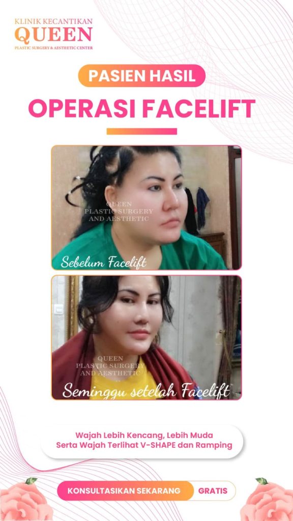 Kenapa Facelift di usia 60-an memberikan hasil paling dramatis? 🤔 Cari tahu jawabannya dan pilih teknik jenis facelift yang tepat di sini!