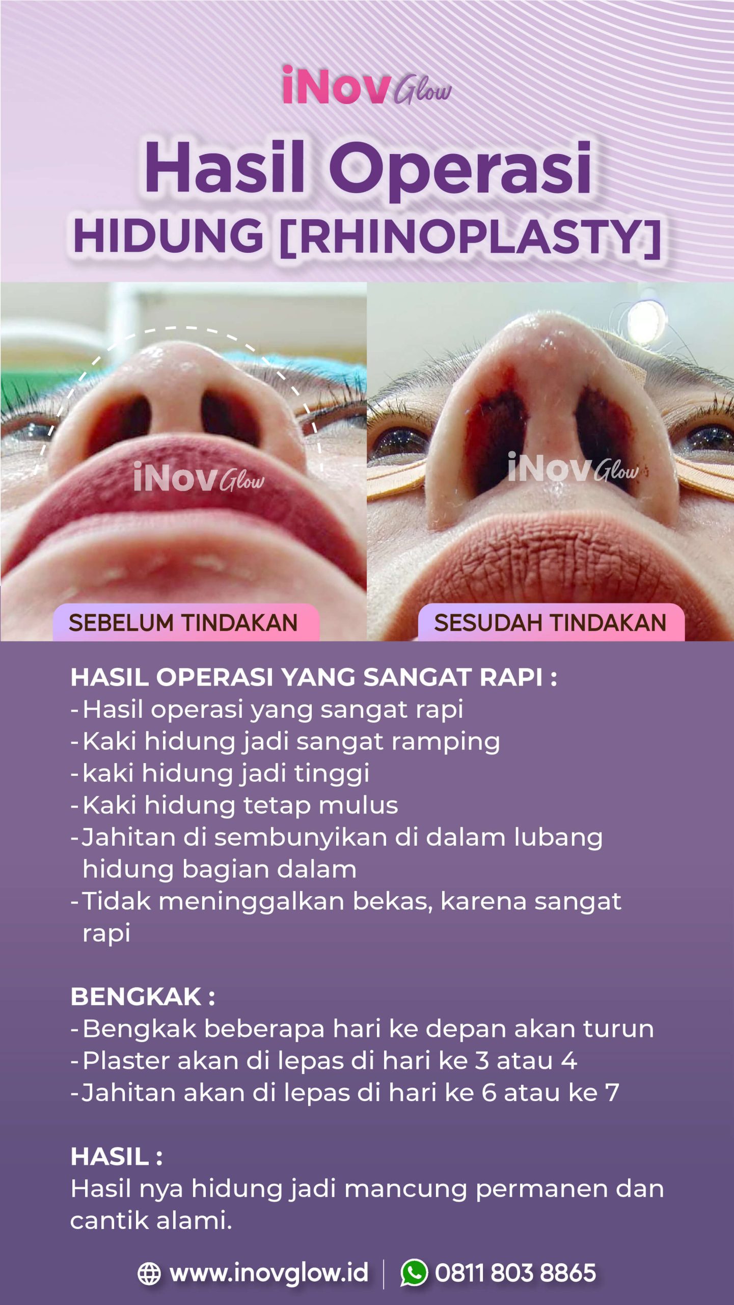 Refleks bersin bisa bikin jahitan hidung lepas? 😲 Ketahui bahaya tersembunyi dan panduan pemulihannya dari Dr. Heri Noviana di artikel ini.