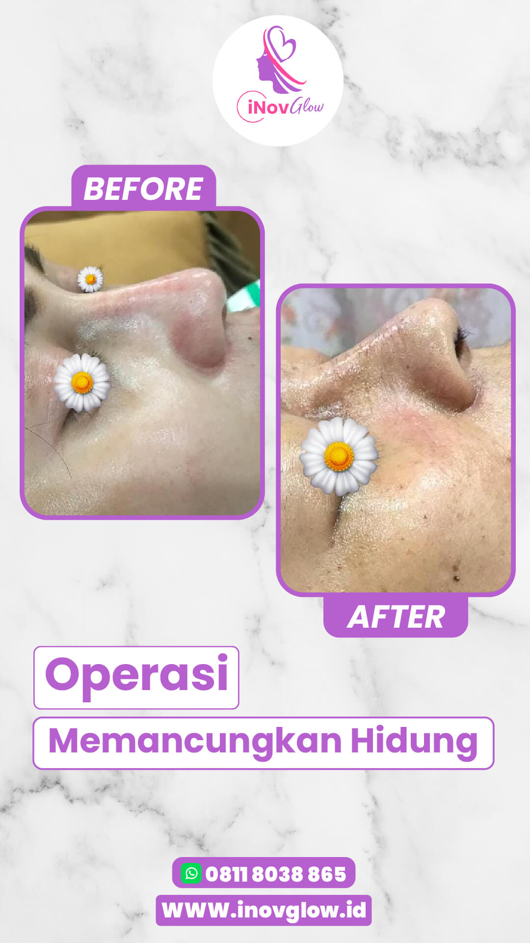 Panduan anti-gagal menahan bersin setelah operasi hidung! 🩹 Amankan masa pemulihan Anda dengan tips medis dari Dr. Heri Noviana.