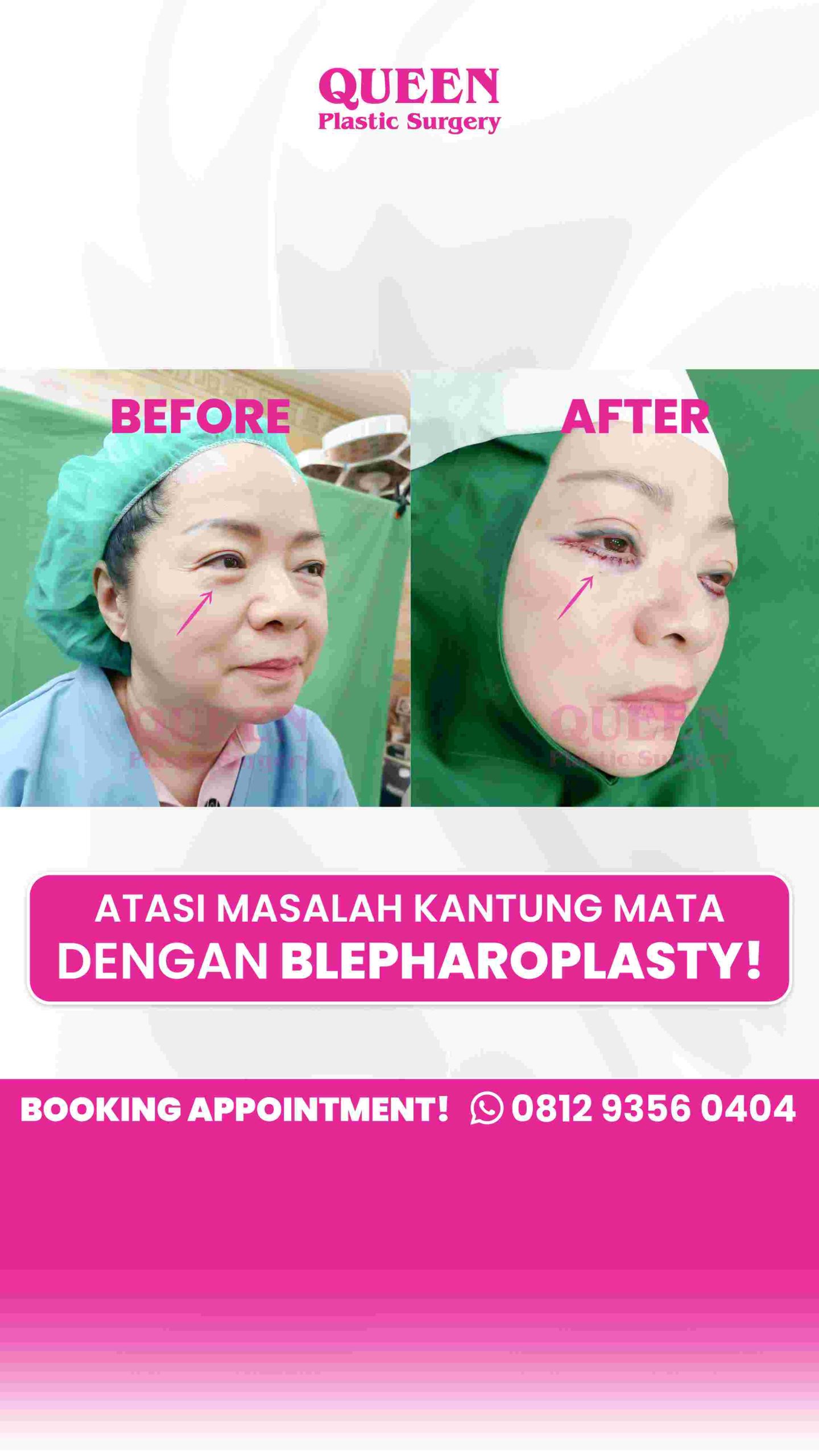 Bukan sekadar operasi biasa, ini alasan kenapa kantung mata butuh penanganan khusus. 💡 Tanya dr. Heri Noviana untuk hasil yang lebih awet!