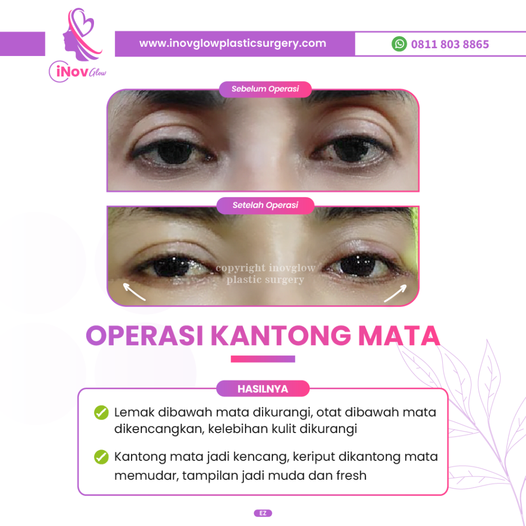 Rahasia wajah segar 10 tahun lebih muda: Gabungkan 2 prosedur ini! Simak penjelasan medis Dr. Heri Noviana sebelum kamu booking jadwal.