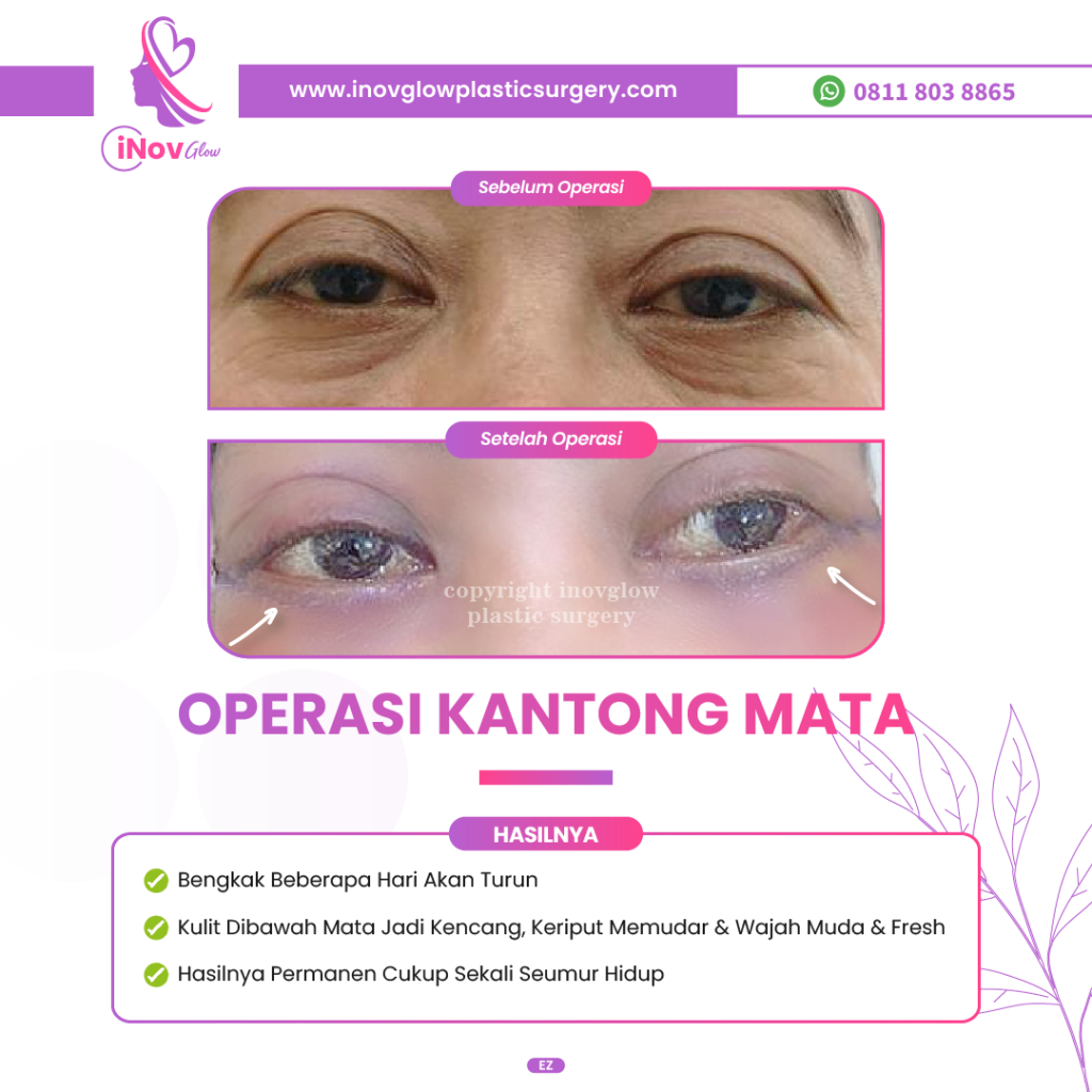 Amankah menggabungkan Blefaroplasti dan Brow Lift dalam satu waktu? ⚠️ Temukan jawaban jujurnya dari Dr. Heri Noviana di artikel ini!